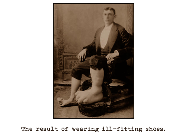 Black and white photograph of a man sitting in a chair dressed in a dinner suit with his trousers rolled up revealing deformed feet and lower legs.  Captioned: The result of wearing ill-fitting shoes.